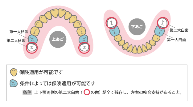 保険でできるリーズナブルな白いかぶせ物